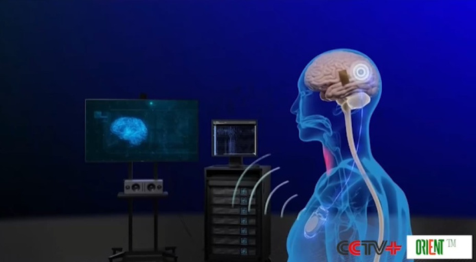 Китайские ученые завершили клинические испытания продукта, представляющего собой интерфейс «мозг-компьютер»